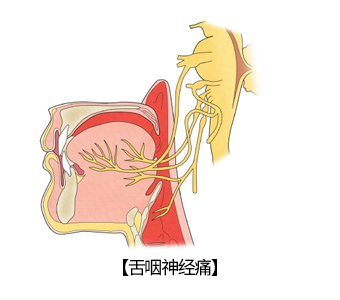 舌咽神经阻滞图片