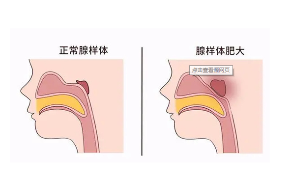 腺样体肥大孩子睡觉呼吸困难