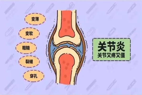 风湿性关节炎有哪些症状表现