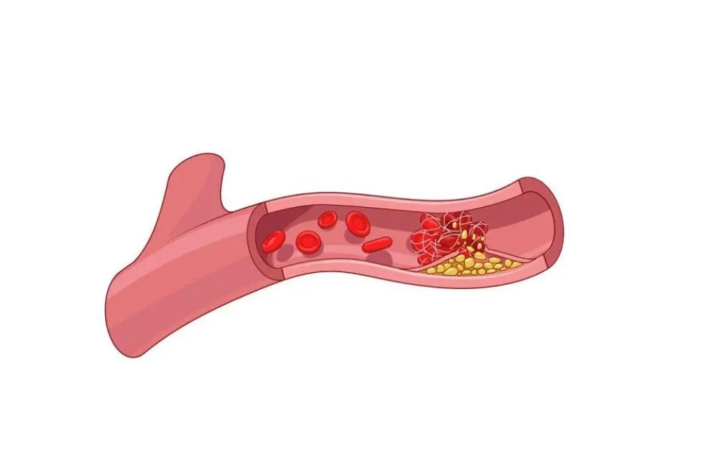 血管血栓形成的深层机制
