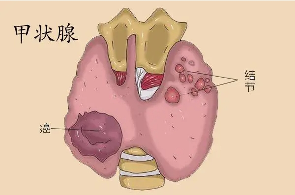 甲状腺结节3类需要治疗吗？